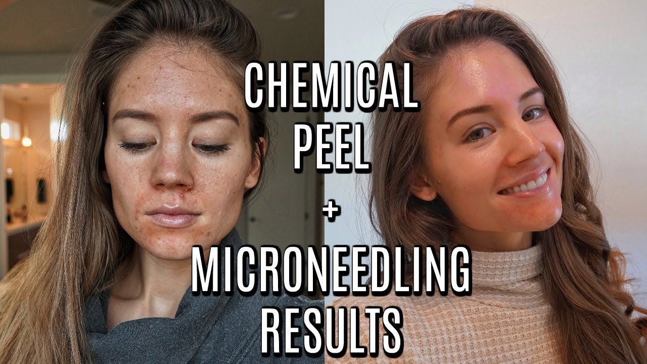 Microneedling Vs Chemical Peel: Which is better for your skin