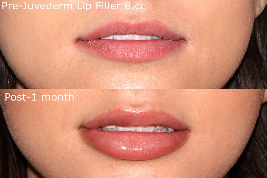Lip Injections San Diego