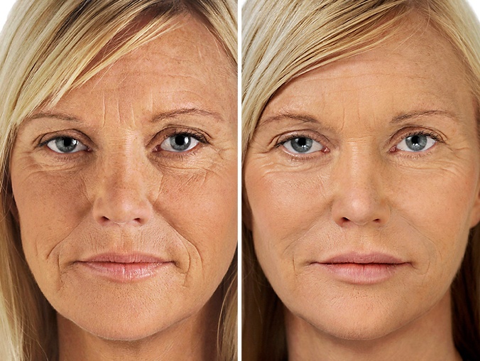 How to Aqua Gold Facial Benefits