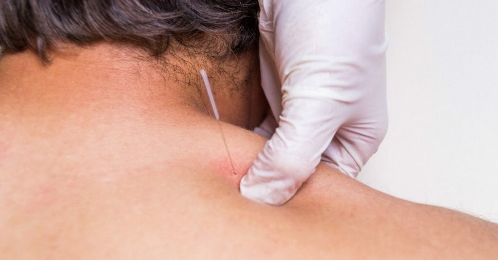 The Pros And Cons Of Dry Needling Benefits