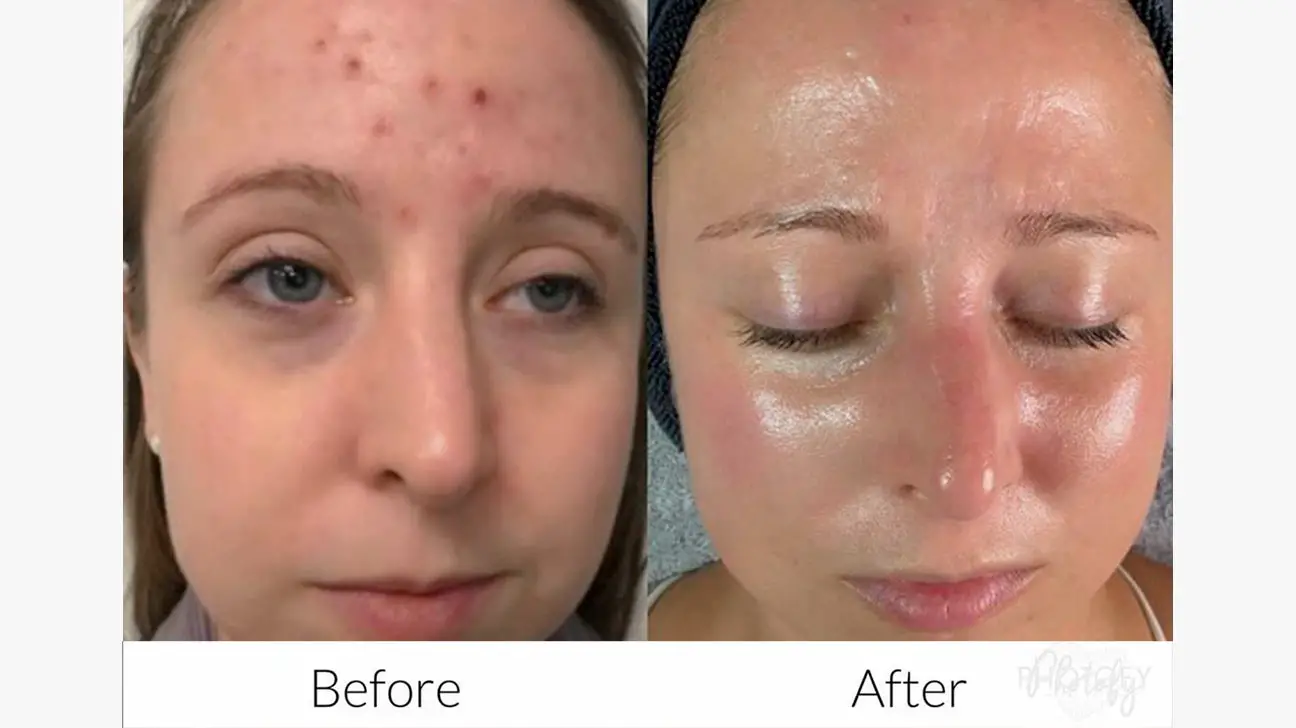 Microneedling Under Eyes