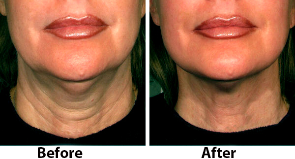 How Long Does Ultherapy Last?