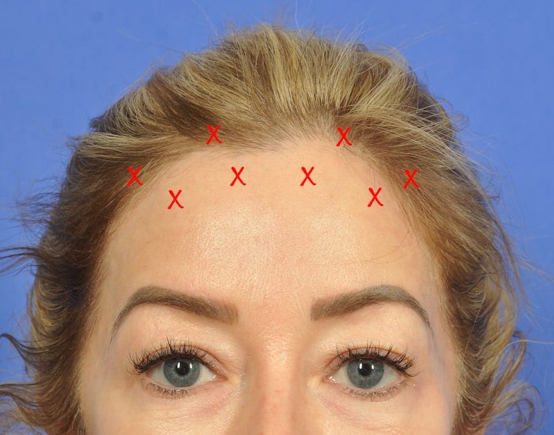 Where To Inject Botox For Brow Lift