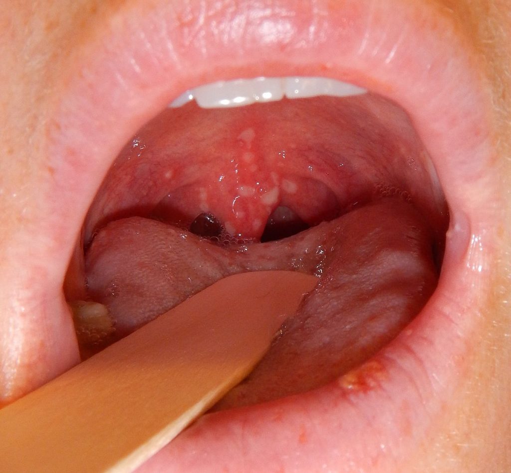 Sore Throat After Wisdom Teeth