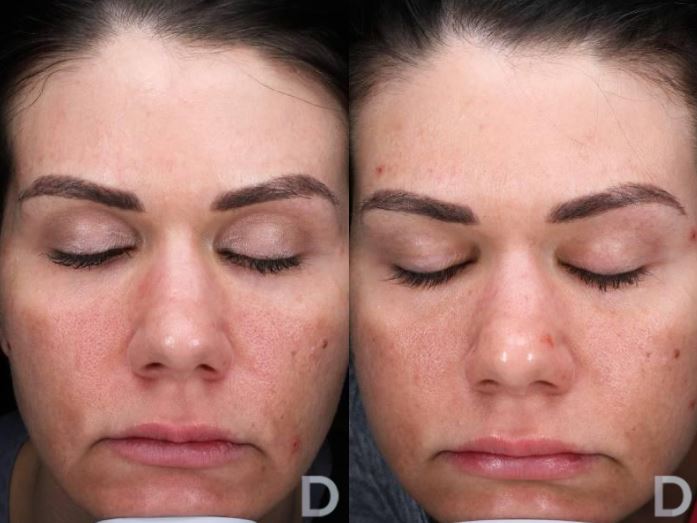How Often Can You Do Microneedling