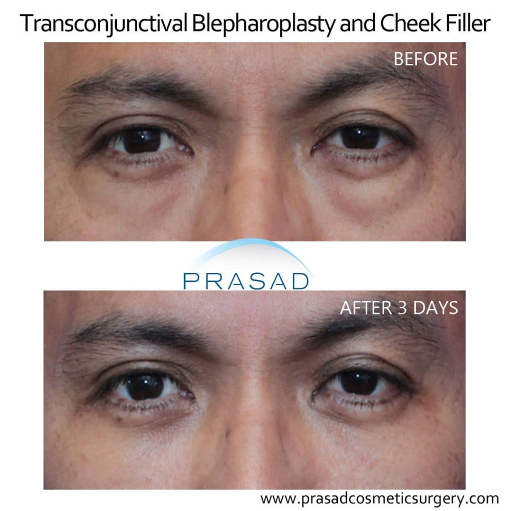 Lower Blepharoplasty Recovery Photos Day by Day