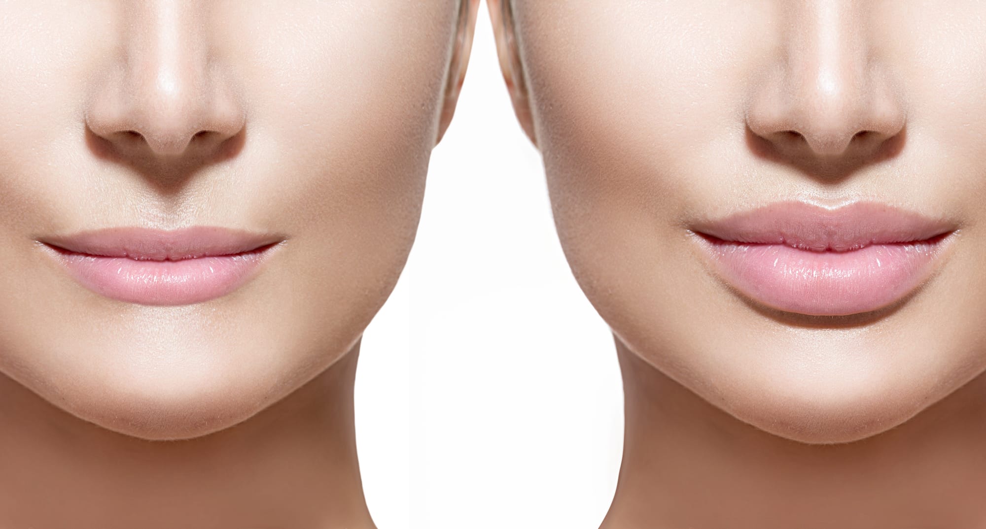 How Long Does Juvederm Last in Lips