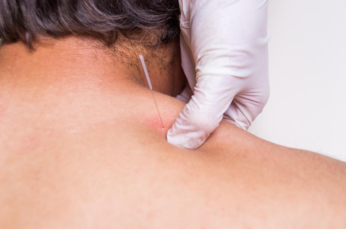 Dry Needling vs Acupuncture ( Which is Better)