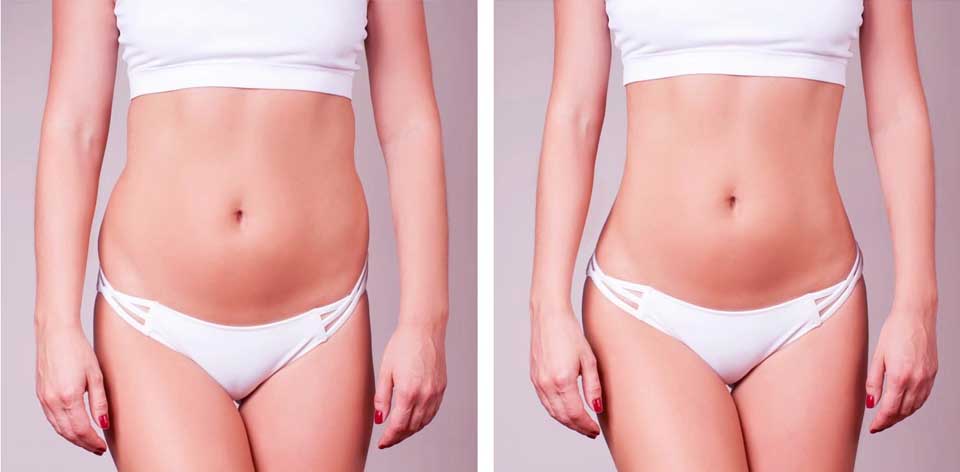 Does Coolsculpting Tighten Skin
