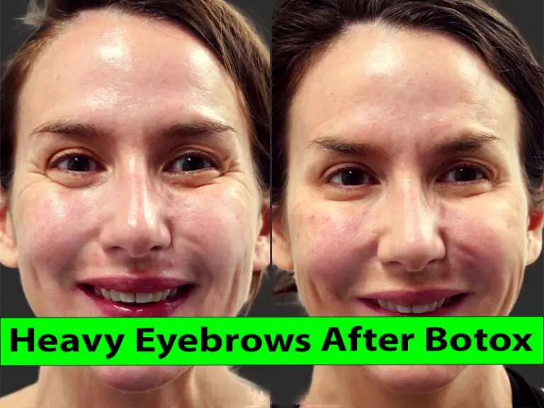 how-to-heavy-eyebrows-after-botox-healthy-anozo