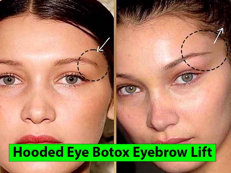 Hooded Eye Botox Eyebrow Lift (10 Benefit And Side Effect)