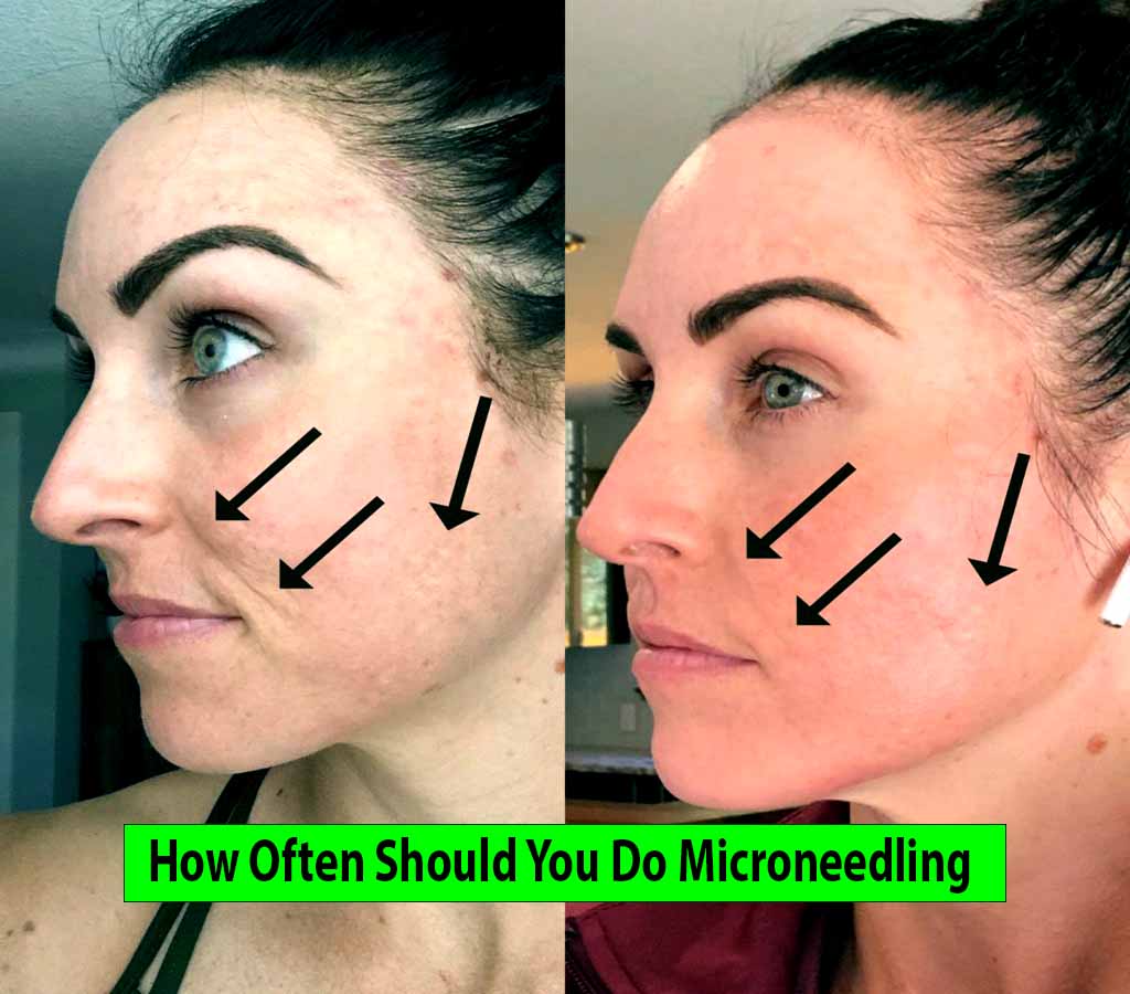 How Often Should You Do Microneedling
