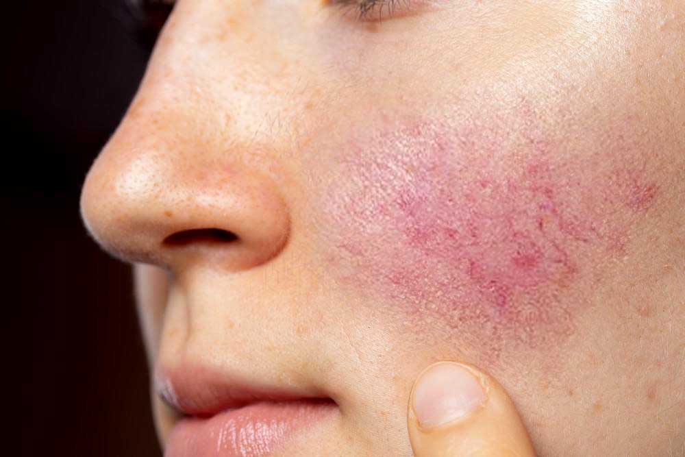 How to Calm Rosacea Flare Up