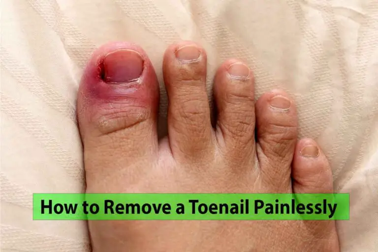 7 Key Permanent Toenail Removal Pros And Cons Healthy Anozo