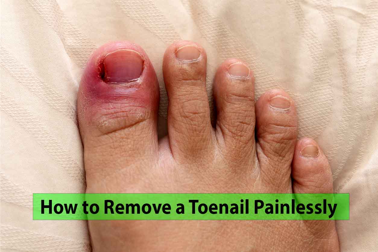 7-key-permanent-toenail-removal-pros-and-cons-healthy-anozo