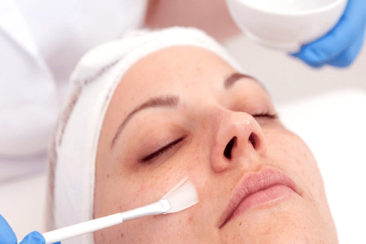 How to Speed Up Peeling After Chemical Peel