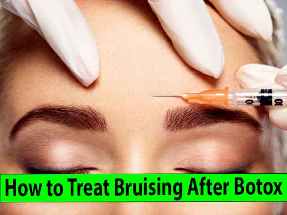 How to Treat Bruising After Botox