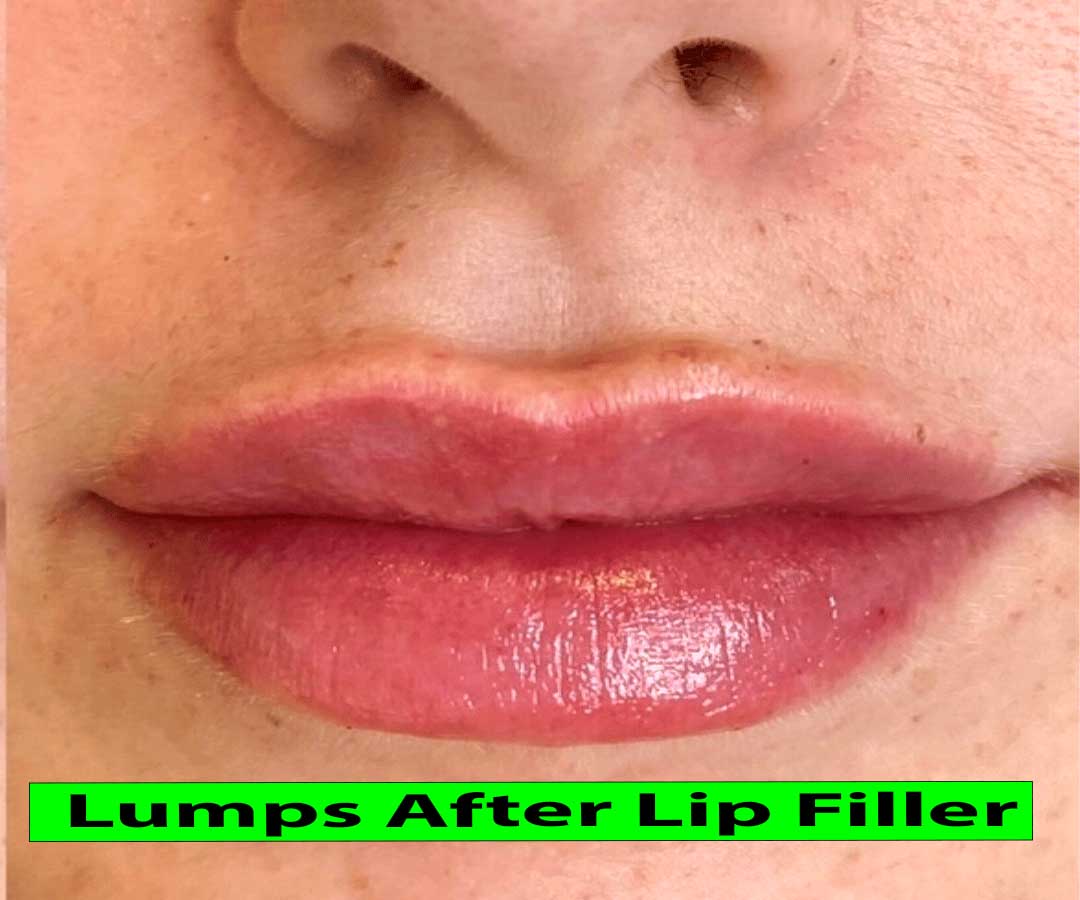 Lumps After Lip Filler