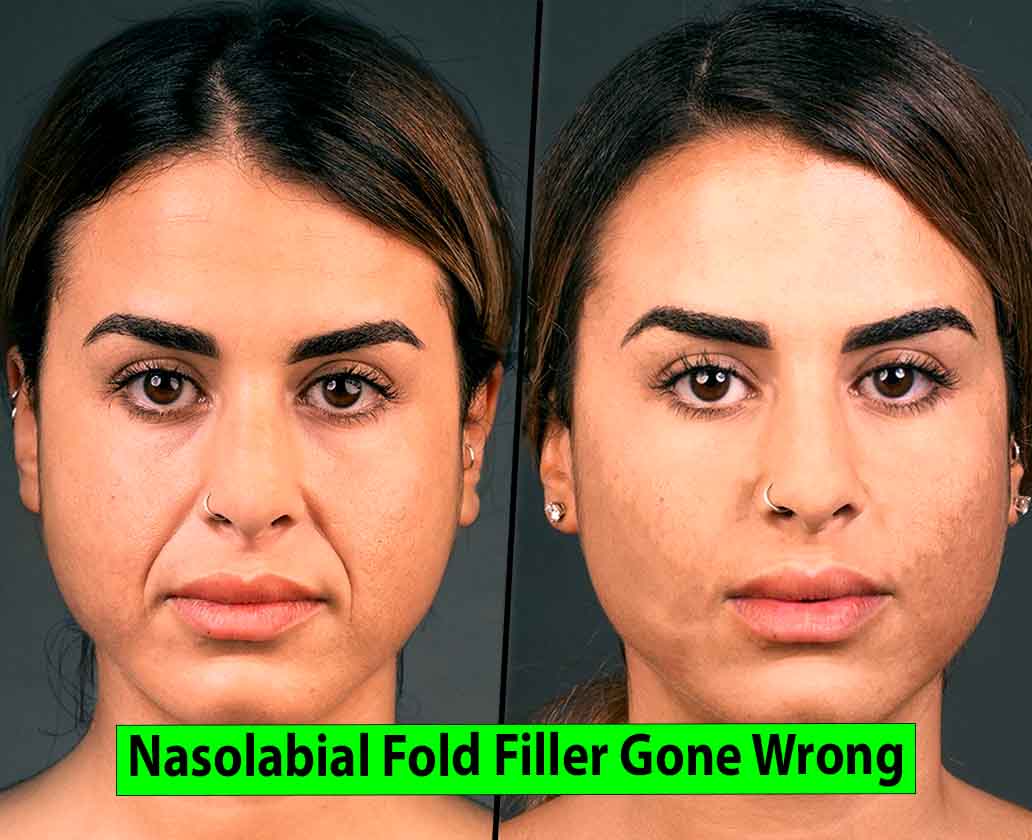 Nasolabial Fold Filler Gone Wrong