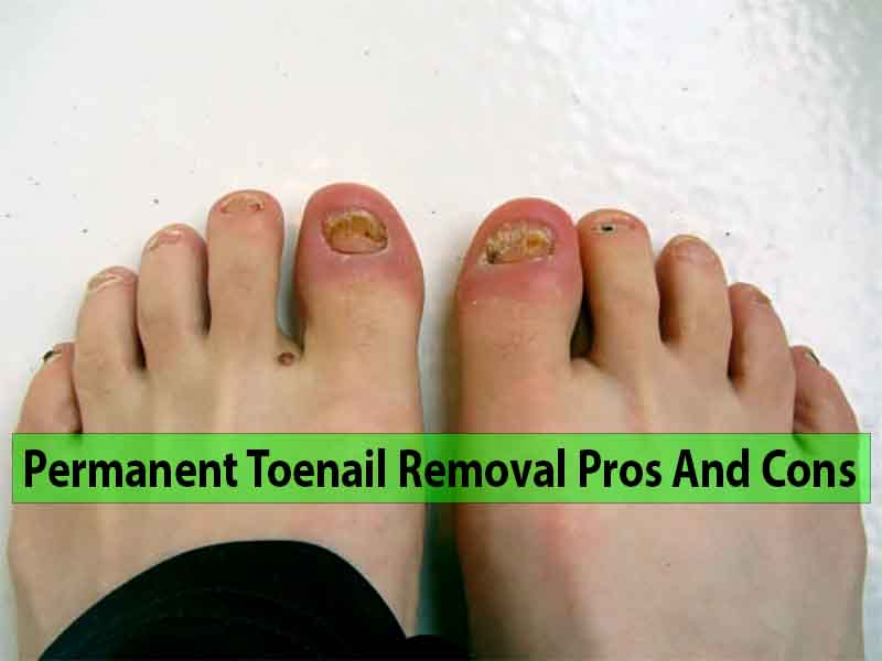 7 Key Permanent Toenail Removal Pros And Cons