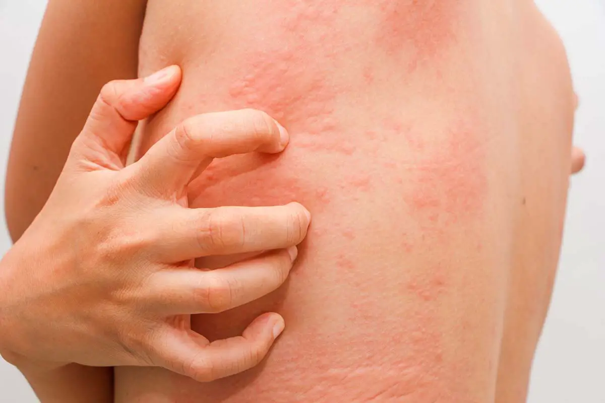 can-seasonal-allergies-cause-itchy-skin