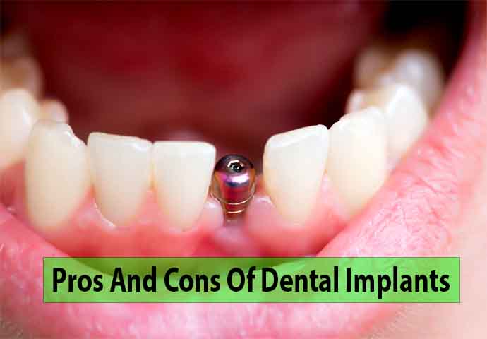 Pros And Cons Of Dental Implants