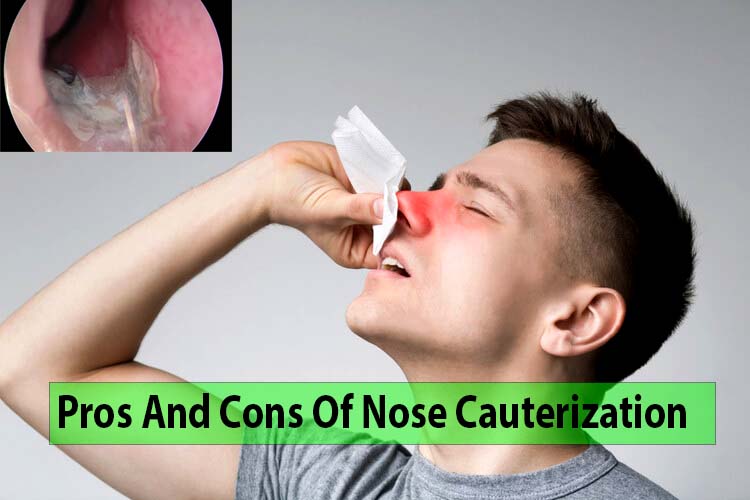 Pros And Cons Of Nose Cauterization