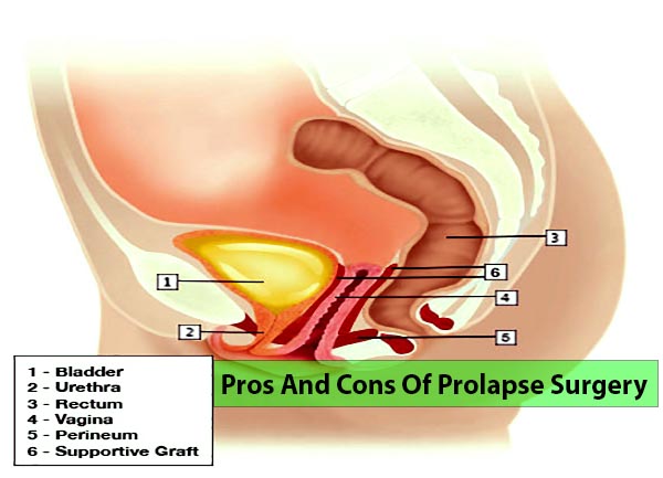 Pros And Cons Of Prolapse Surgery