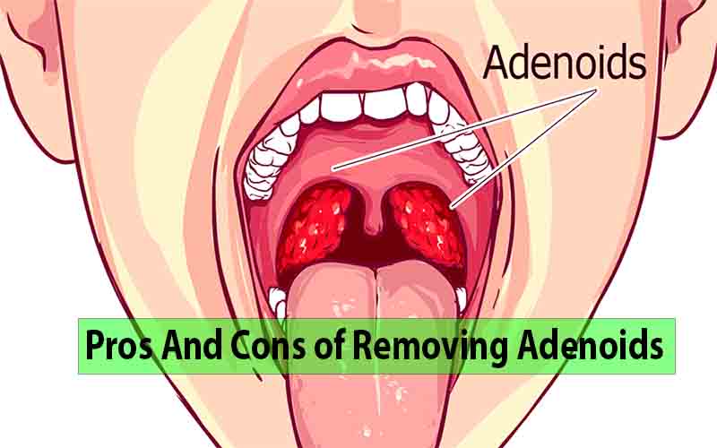Pros And Cons of Removing Adenoids