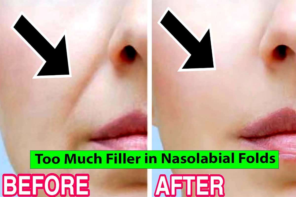 Too Much Filler in Nasolabial Folds