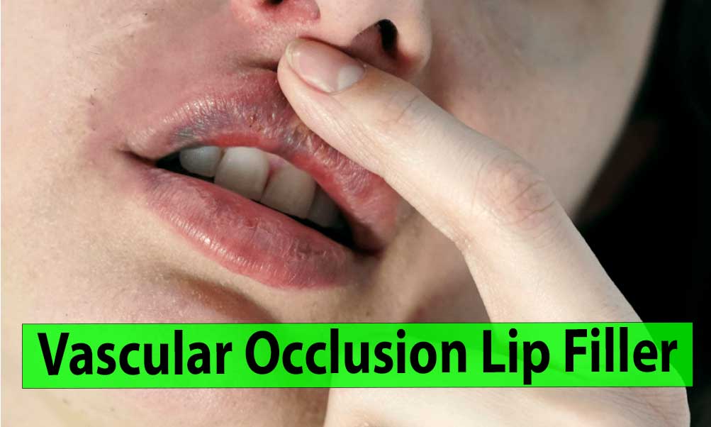 Vascular Occlusion Lip Filler