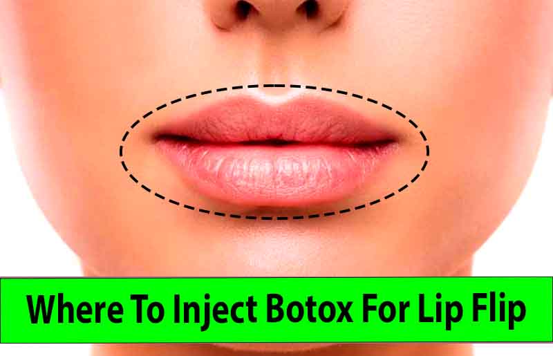 Where To Inject Botox For Lip Flip