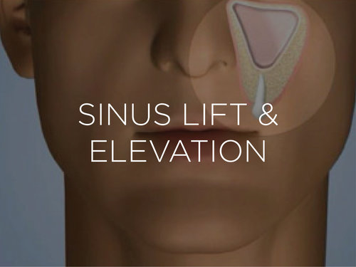 Sinus Lift Surgery Swelling