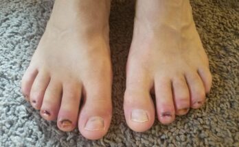 What is Permanent Toenail Removal Pros And Cons