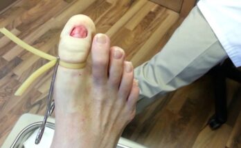 Permanent Toenail Removal