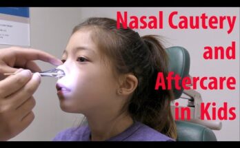Nose Cauterizations: Pros And Cons